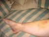 Nat\'s leg bruises