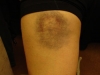 Lisa\'s bruise