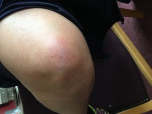 Maz's bruised knee
